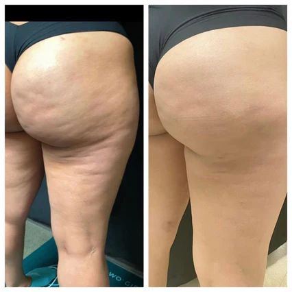 Ventre plus plat, cuisses plus galbée
