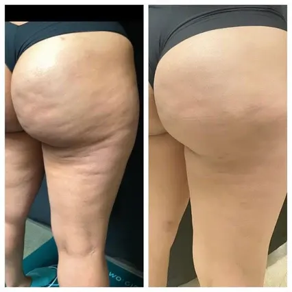 Ventre plus plat, cuisses plus galbée